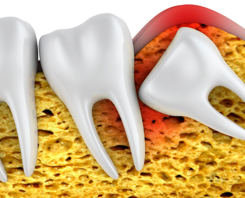 Wisdom Teeth Removal Monroe and Mint Hill Union Oral Surgery