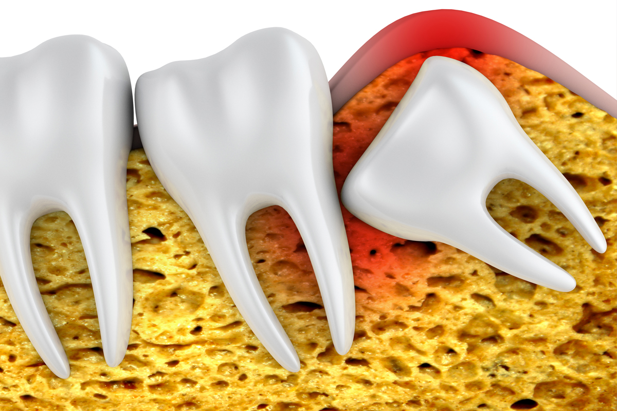 wisdom teeth signs